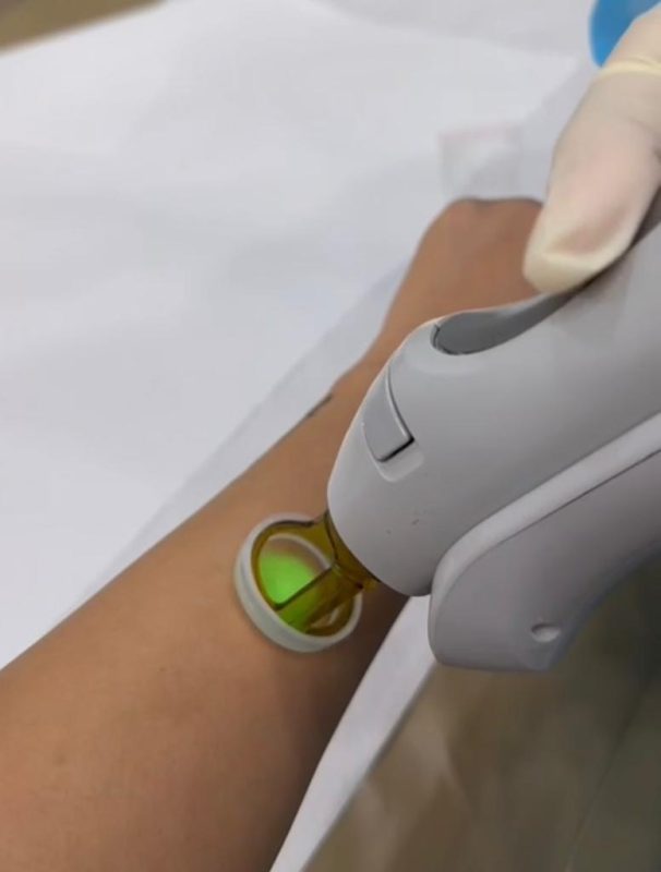 قطعة الليزر لازالة الشعر استخدام مرة واحدة مقاس 18